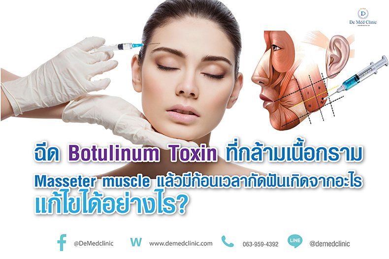 ฉีด Botulinum Toxin ที่กล้ามเนื้อกราม Masseter muscleแล้วมีก้อนเวลากัดฟันเกิดจากอะไร แก้ไขได้อย่างไร?