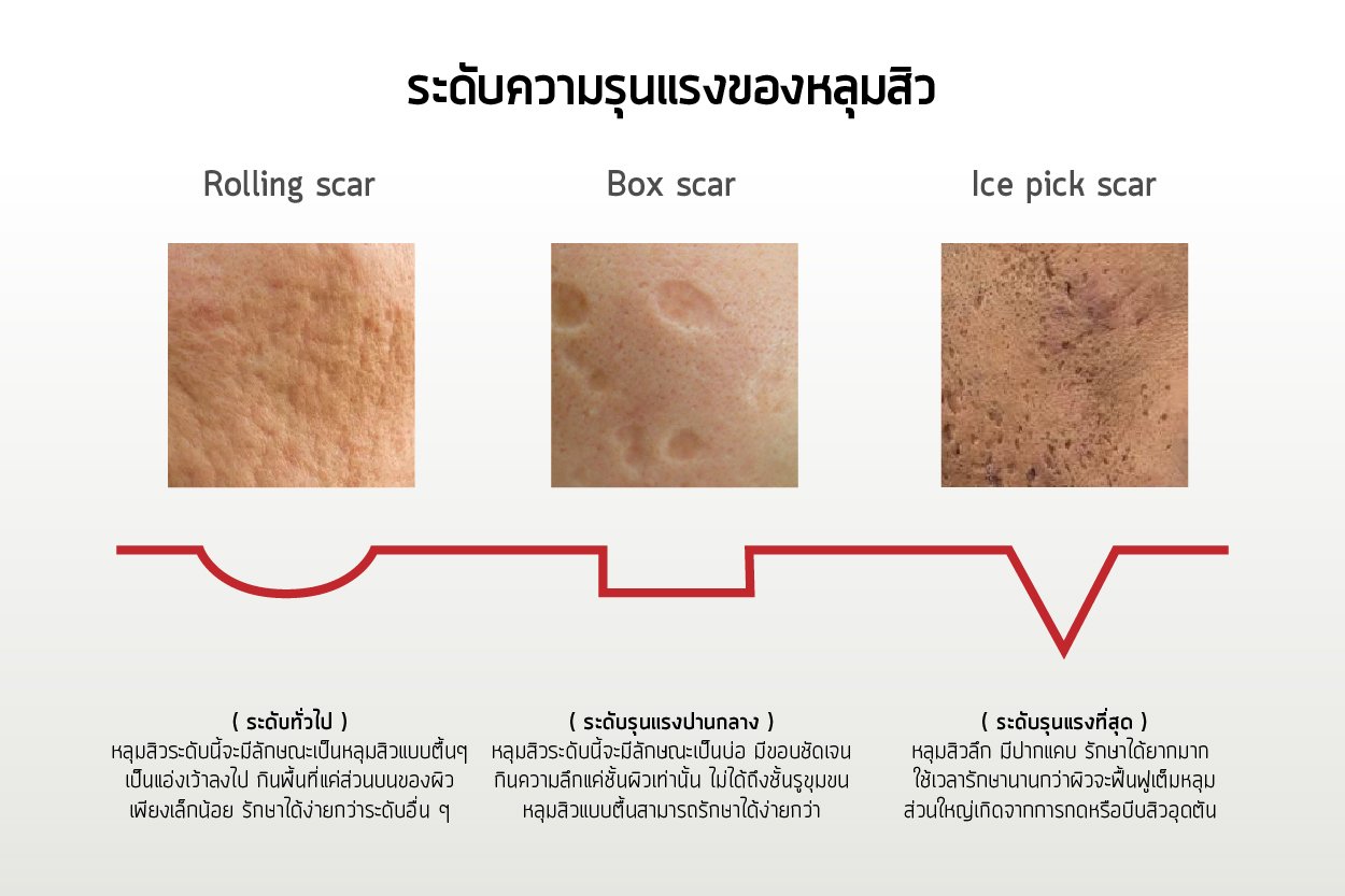 การรักษารอยแผลเป็นแบบหลุมจากสิว Atrophic Acne Scar ด้วยการผ่าตัด Scar Revision คืออะไร ? การรักษารอยแผลเป็นแบบหลุมจากสิว Atrophic Acne Scar ด้วยการผ่าตัด Scar Revision คืออะไร ?
