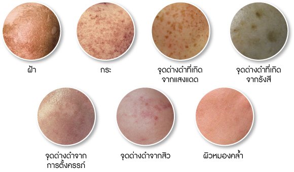 ฝ้ามีกี่ชนิด Melasma Type? ฝ้ามีกี่ชนิด Melasma Type?