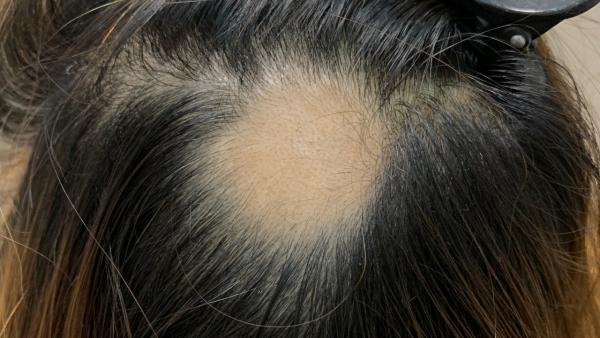 ภาวะผมร่วงเป็นหย่อม Alopecia Areata AA หลังฉีดวัคซีนโควิด-19 เกิดจากอะไรดูแลได้ อย่างไร? ภาวะผมร่วงเป็นหย่อม Alopecia Areata AA หลังฉีดวัคซีนโควิด-19 เกิดจากอะไรดูแลได้ อย่างไร?
