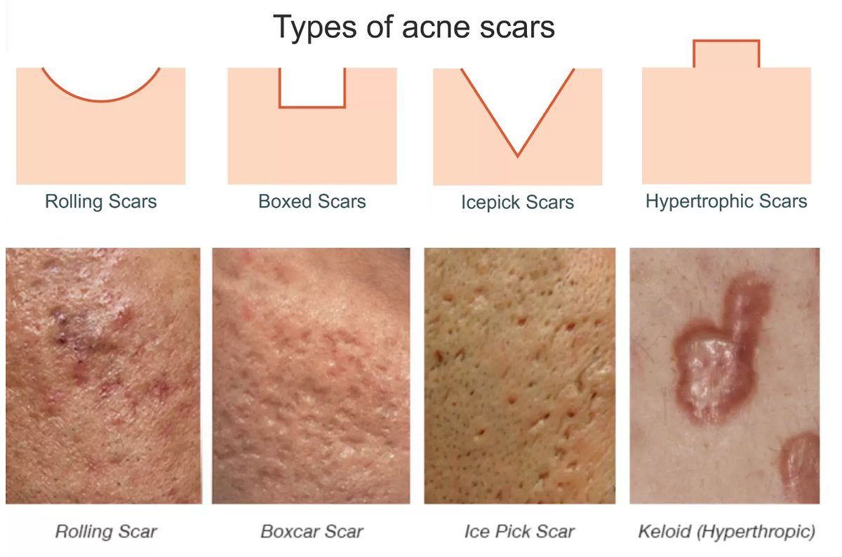 Boxcar scar หลุมสิวแบบกล่อง มีลักษณะอย่างไร ดูแลได้อย่างไร ? Boxcar scar หลุมสิวแบบกล่อง มีลักษณะอย่างไร ดูแลได้อย่างไร ?