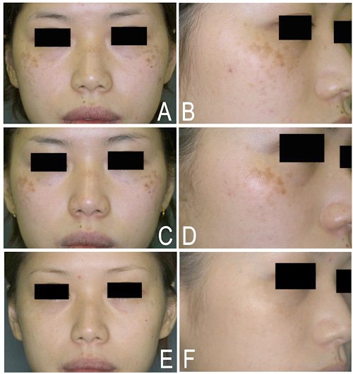 ดูแลปานดำโอตะ Nevus of Ota ด้วย Picosecond Laser