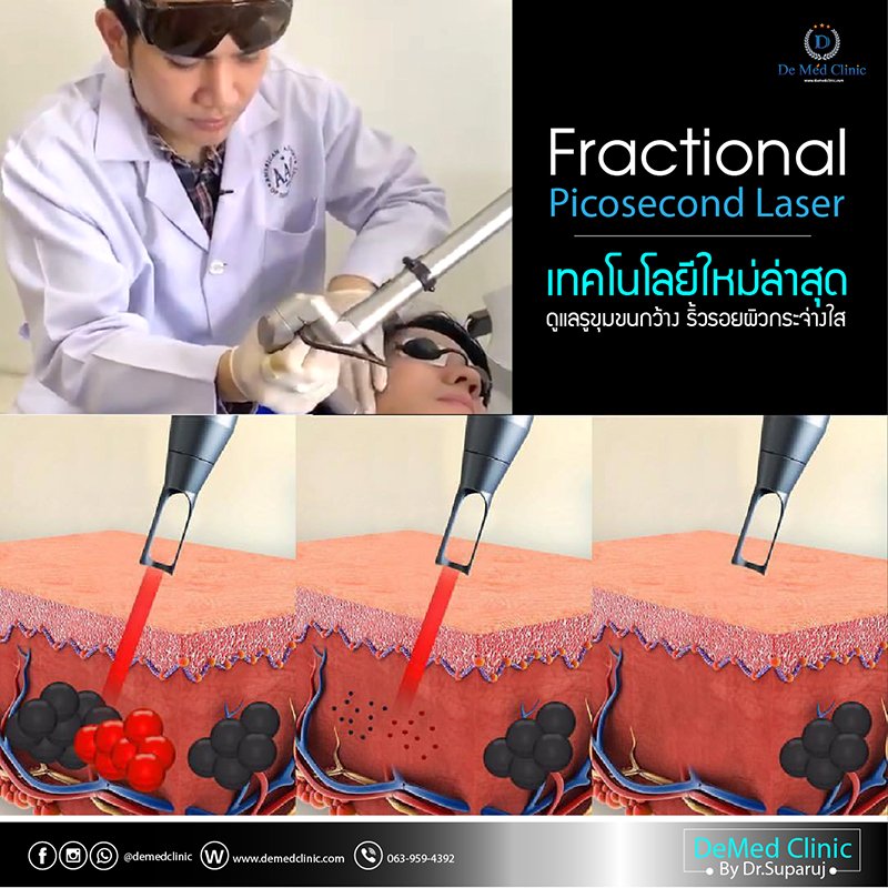 Fractional Picosecond Laser เทคโนโลยีใหม่ล่าสุด ดูแลรูขุมขนกว้าง ริ้วรอยผิวกระจ่างใส