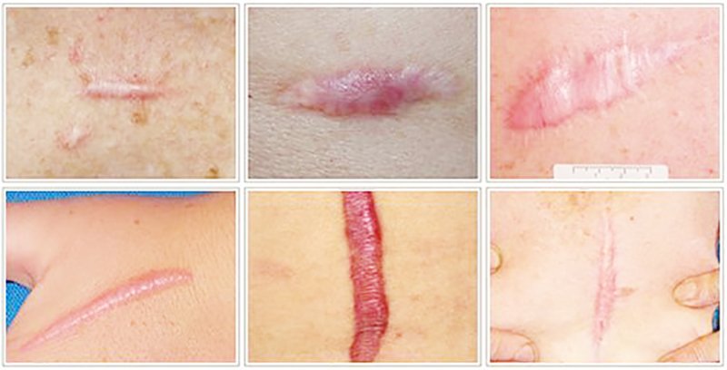 Update เทคนิคการรักษาแผลเป็นคีลอยด์ 2021 Update Scar and Keloid Management Update เทคนิคการรักษาแผลเป็นคีลอยด์ 2021 Update Scar and Keloid Management