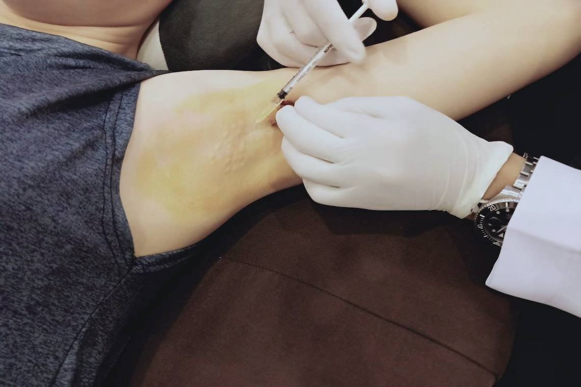 การฉีด โบทูลินั่มท็อกซิน Botulinum Toxin (Botox) เพื่อรักษาภาวะเหงื่อออกมาก (Hyperhidrosis) เฉพาะที่  การฉีด โบทูลินั่มท็อกซิน Botulinum Toxin (Botox) เพื่อรักษาภาวะเหงื่อออกมาก (Hyperhidrosis) เฉพาะที่