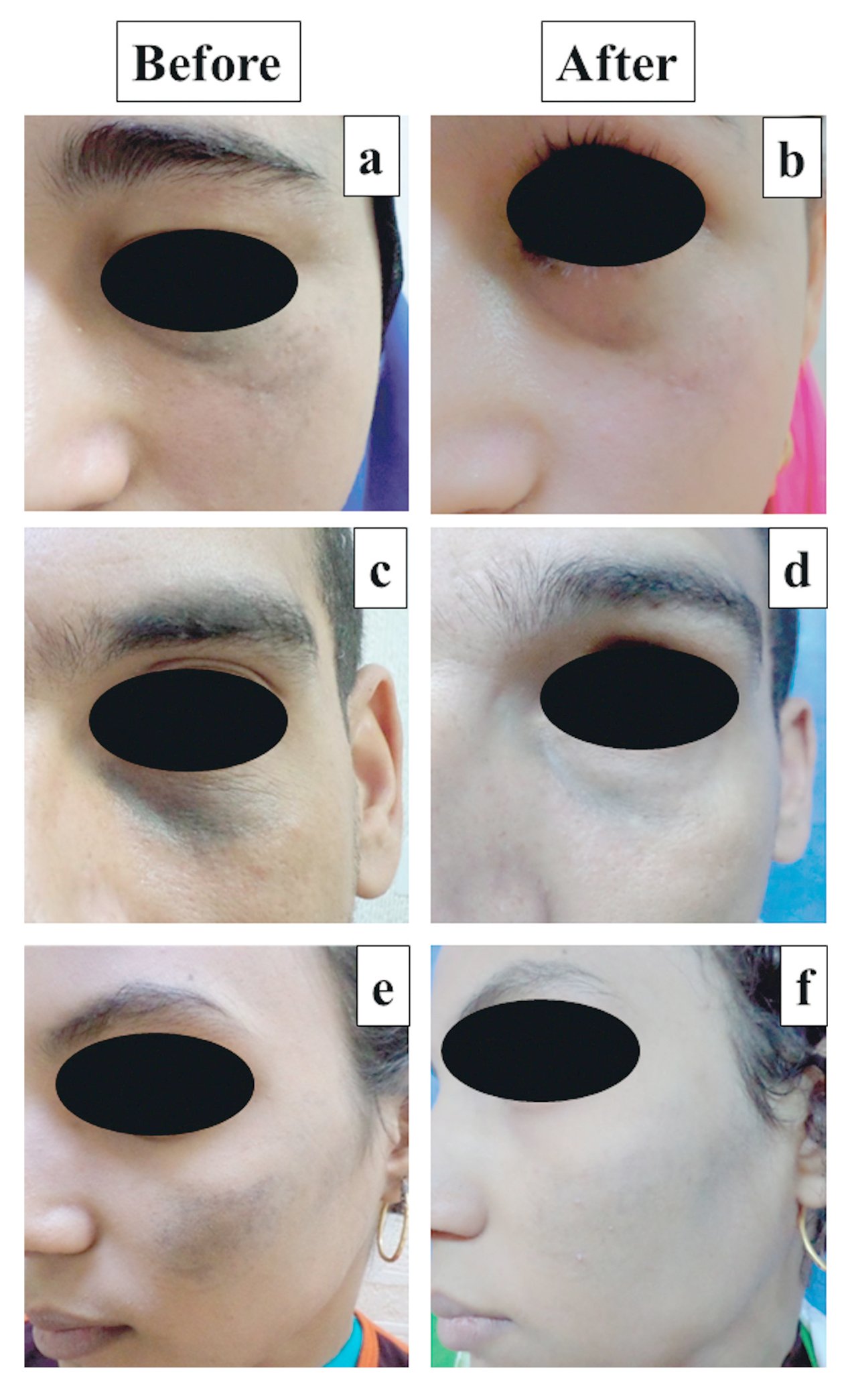 ดูแลปานดำโอตะ Nevus of Ota ด้วย Picosecond Laser