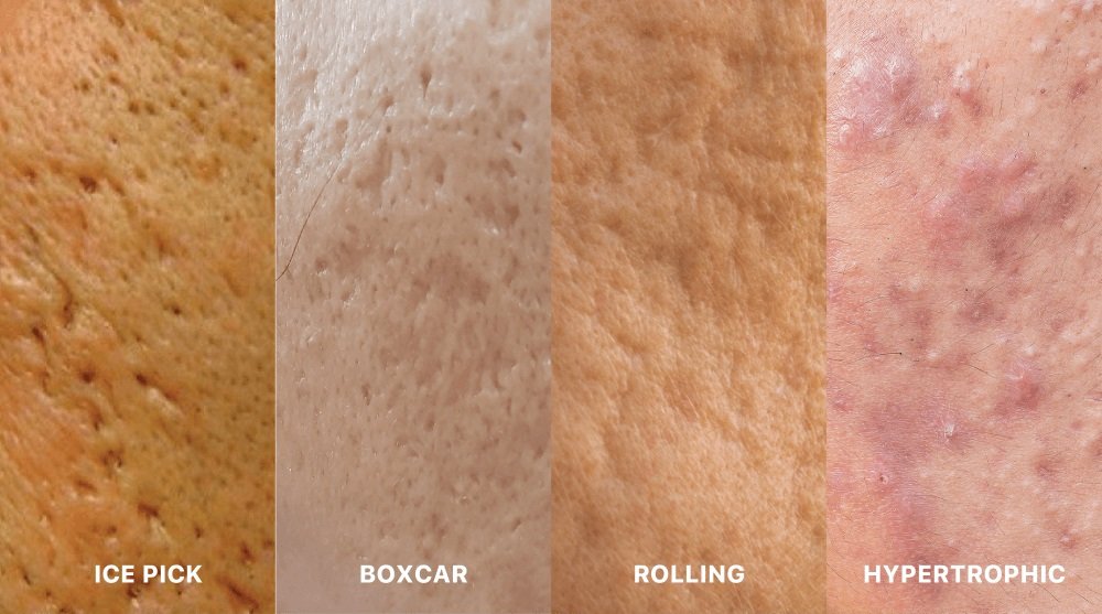 ดูแลหลุมสิวด้วยเทคนิคศัลยกรรมหลุมสิว Acne Scar Revision Surgery คืออะไร ดูแลหลุมสิวด้วยเทคนิคศัลยกรรมหลุมสิว Acne Scar Revision Surgery คืออะไร