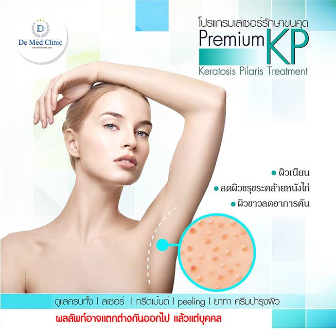 โปรแกรมเลเซอร์รักษาขนคุด Keratosis Pilaris (KP) Premium KP Laser Treatment Program 