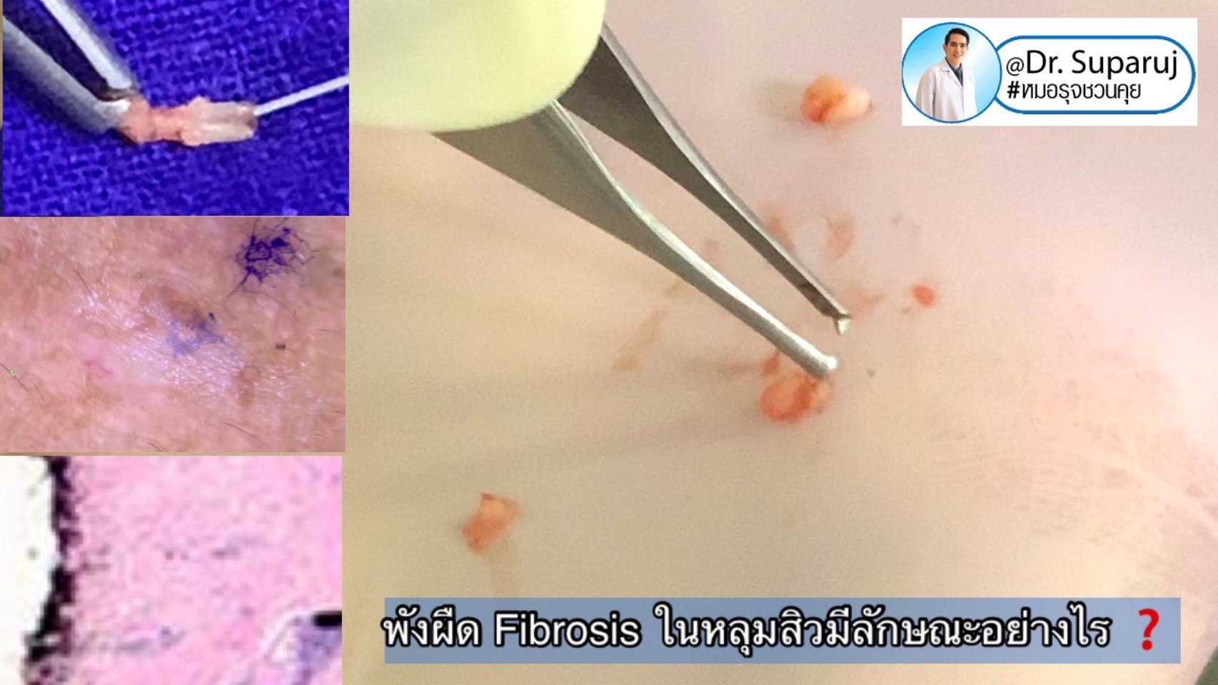 พังผืด Fibrosis ในหลุมสิวมีลักษณะอย่างไร ? พังผืด Fibrosis ในหลุมสิวมีลักษณะอย่างไร ?