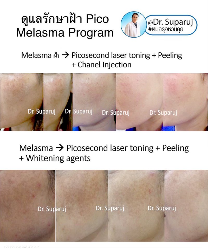 เป็นฝ้าแล้วต้องรีบเลเซอร์ไหม? เป็นฝ้าแล้วต้องรีบเลเซอร์ไหม?