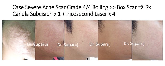 หลุมสิวแบบปากแคบ Icepick acne scar หลุมสิวแบบปากแคบ Icepick acne scar