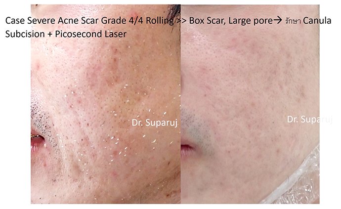 หลุมสิวแบบปากแคบ Icepick acne scar หลุมสิวแบบปากแคบ Icepick acne scar