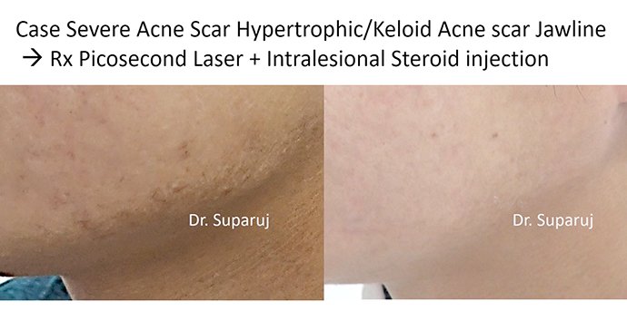 หลุมสิวแบบปากแคบ Icepick acne scar หลุมสิวแบบปากแคบ Icepick acne scar
