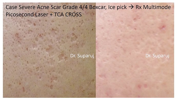 หลุมสิวแบบปากแคบ Icepick acne scar หลุมสิวแบบปากแคบ Icepick acne scar