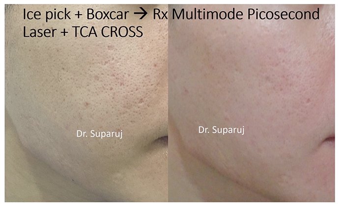 หลุมสิวแบบปากแคบ Icepick acne scar หลุมสิวแบบปากแคบ Icepick acne scar