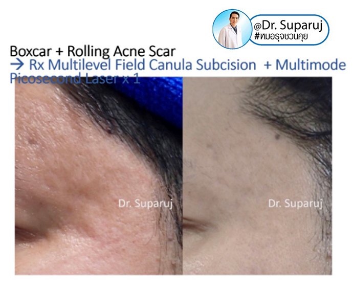 หลุมสิวแบบปากแคบ Icepick acne scar หลุมสิวแบบปากแคบ Icepick acne scar