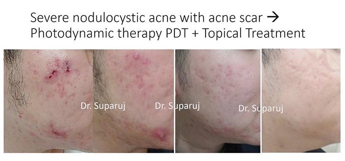 หลุมสิวแบบปากแคบ Icepick acne scar หลุมสิวแบบปากแคบ Icepick acne scar