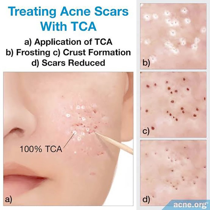 หลุมสิวแบบปากแคบ Icepick acne scar