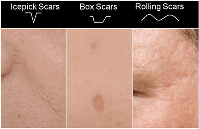 หลุมสิวแบบปากแคบ Icepick acne scar หลุมสิวแบบปากแคบ Icepick acne scar