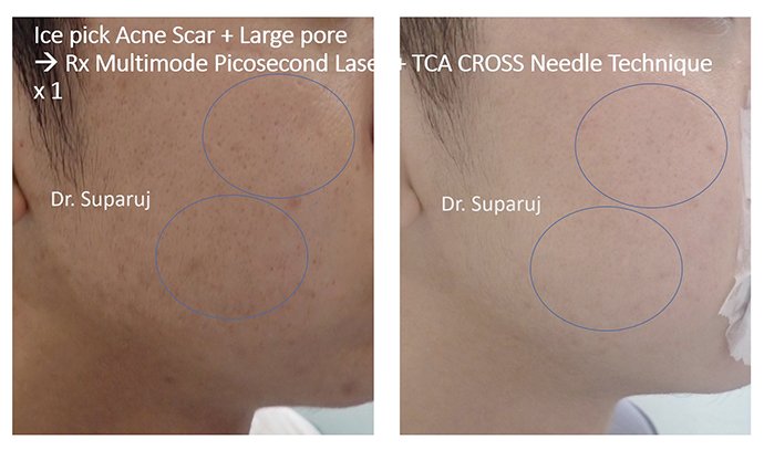 หลุมสิวแบบปากแคบ Icepick acne scar หลุมสิวแบบปากแคบ Icepick acne scar