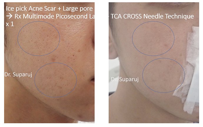 หลุมสิวแบบปากแคบ Icepick acne scar หลุมสิวแบบปากแคบ Icepick acne scar