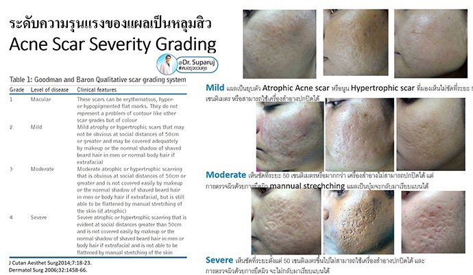 ผลลัพธ์อาจแตกต่างกันไป แล้วแต่บุคคล ผลลัพธ์อาจแตกต่างกันไป แล้วแต่บุคคล