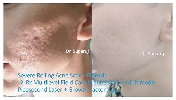 เทคนิคการดูแลหลุมสิวแบบกล่อง Boxcar scar เทคนิคการดูแลหลุมสิวแบบกล่อง Boxcar scar