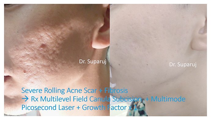 เทคนิคการดูแลหลุมสิวแบบกล่อง Boxcar scar