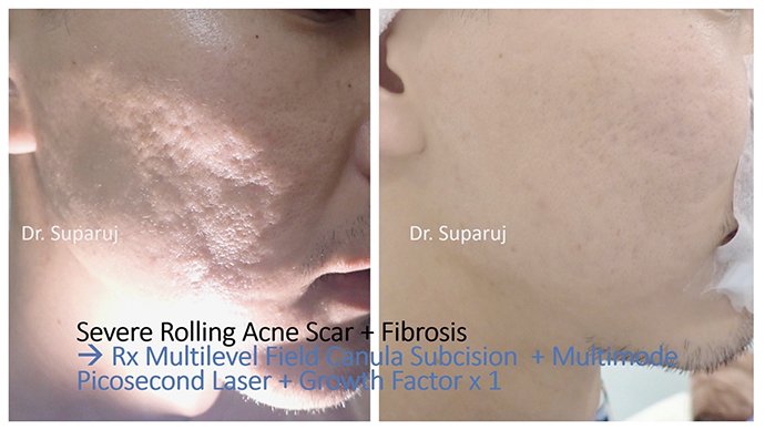 เทคนิคการดูแลหลุมสิวแบบกล่อง Boxcar scar เทคนิคการดูแลหลุมสิวแบบกล่อง Boxcar scar