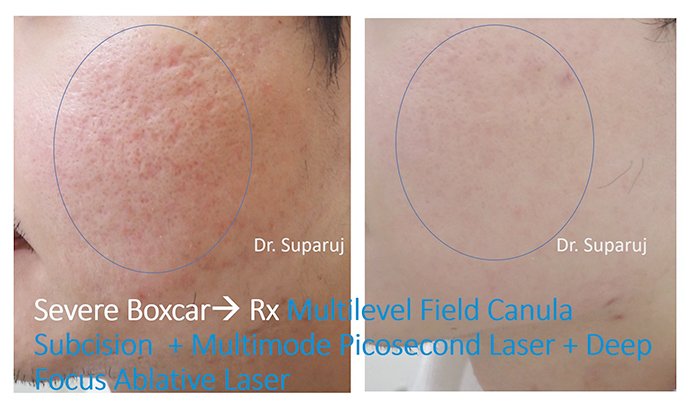 เทคนิคการดูแลหลุมสิวแบบกล่อง Boxcar scar