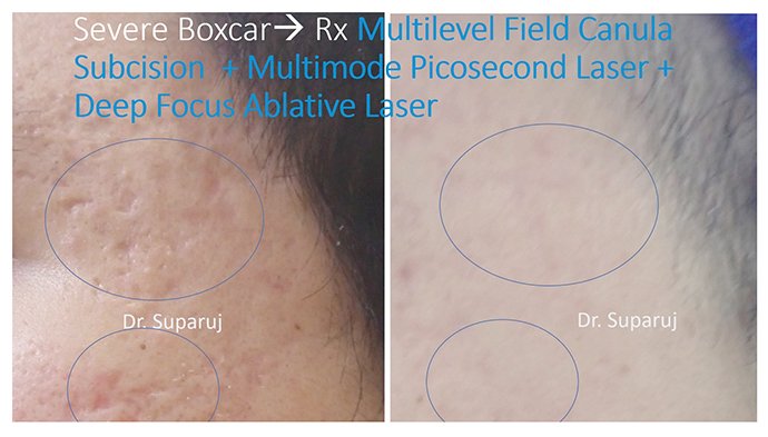 เทคนิคการดูแลหลุมสิวแบบกล่อง Boxcar scar เทคนิคการดูแลหลุมสิวแบบกล่อง Boxcar scar