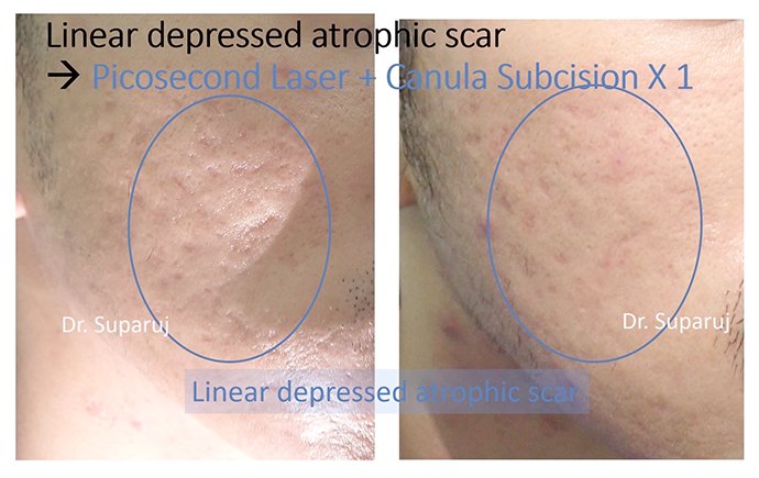 ผลลัพธ์อาจแตกต่างกันไป แล้วแต่บุคคล ผลลัพธ์อาจแตกต่างกันไป แล้วแต่บุคคล