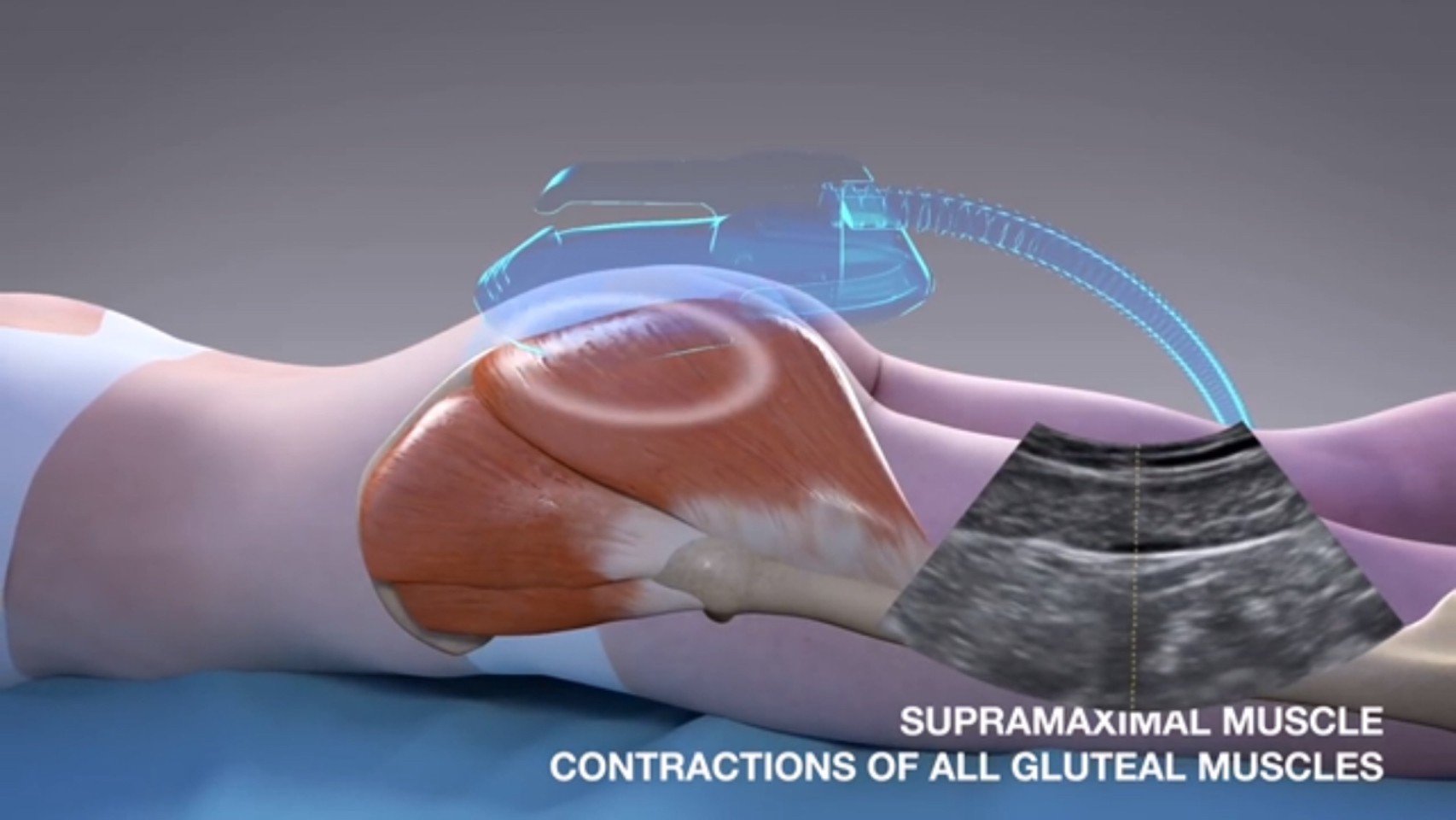 นวัตกรรมสร้างกล้ามเนื้อสลายไขมันด้วย Emsculpt นวัตกรรมสร้างกล้ามเนื้อสลายไขมันด้วย Emsculpt