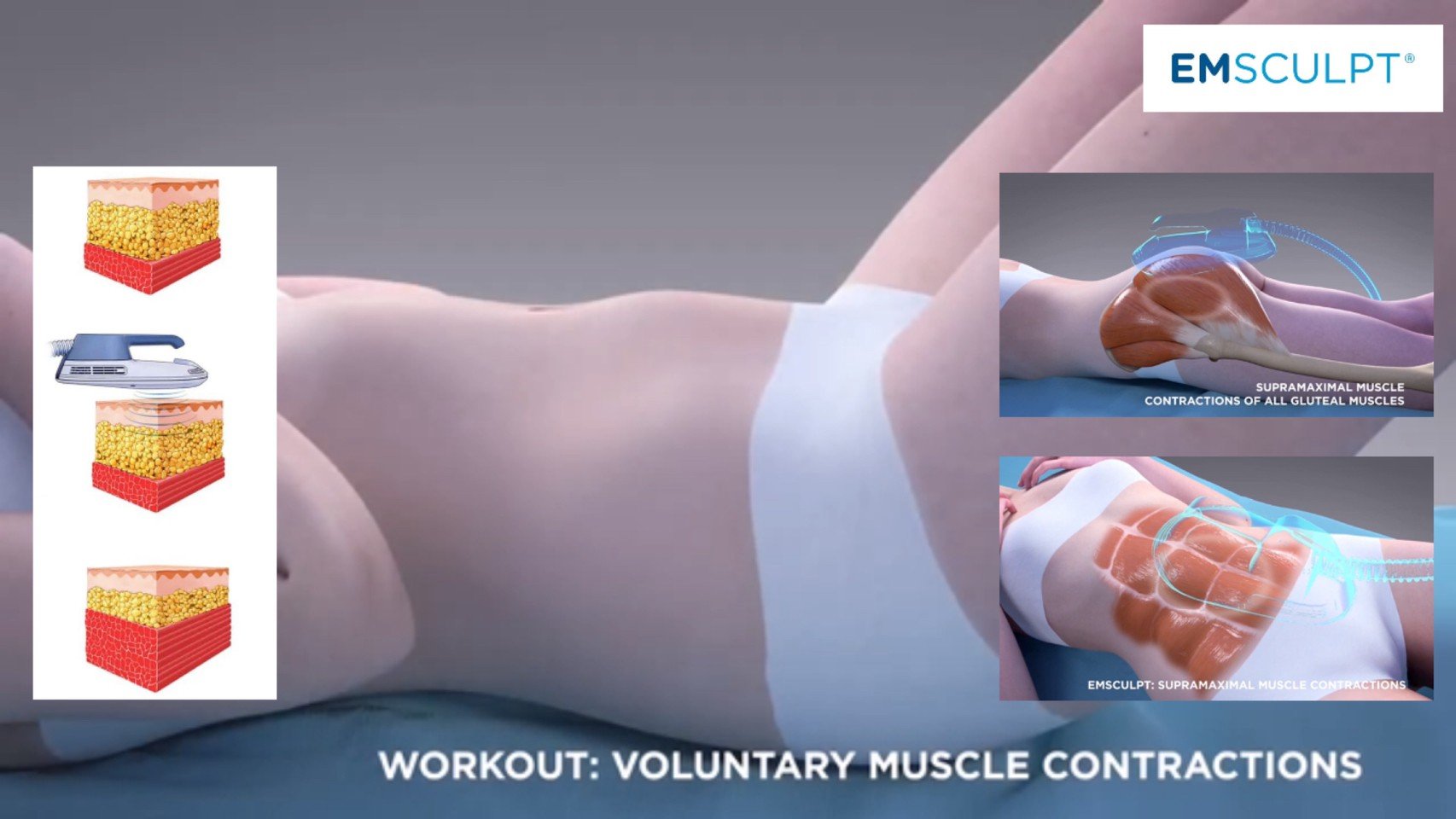 นวัตกรรมสร้างกล้ามเนื้อสลายไขมันด้วย Emsculpt นวัตกรรมสร้างกล้ามเนื้อสลายไขมันด้วย Emsculpt