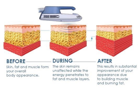 นวัตกรรมสร้างกล้ามเนื้อสลายไขมันด้วย Emsculpt นวัตกรรมสร้างกล้ามเนื้อสลายไขมันด้วย Emsculpt
