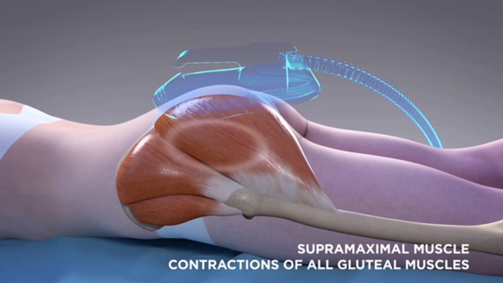 นวัตกรรมสร้างกล้ามเนื้อสลายไขมันด้วย Emsculpt นวัตกรรมสร้างกล้ามเนื้อสลายไขมันด้วย Emsculpt