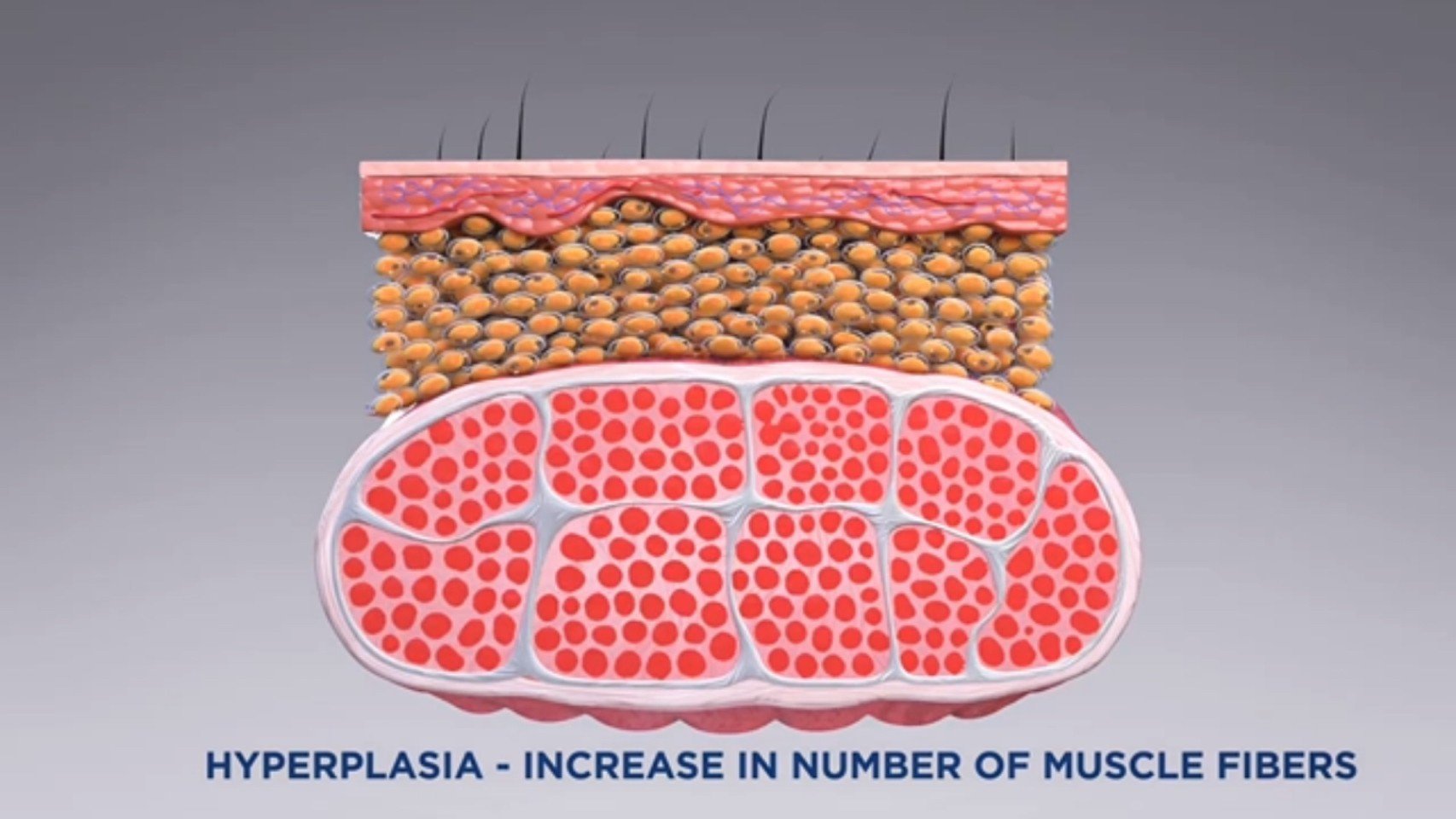 นวัตกรรมสร้างกล้ามเนื้อสลายไขมันด้วย Emsculpt นวัตกรรมสร้างกล้ามเนื้อสลายไขมันด้วย Emsculpt