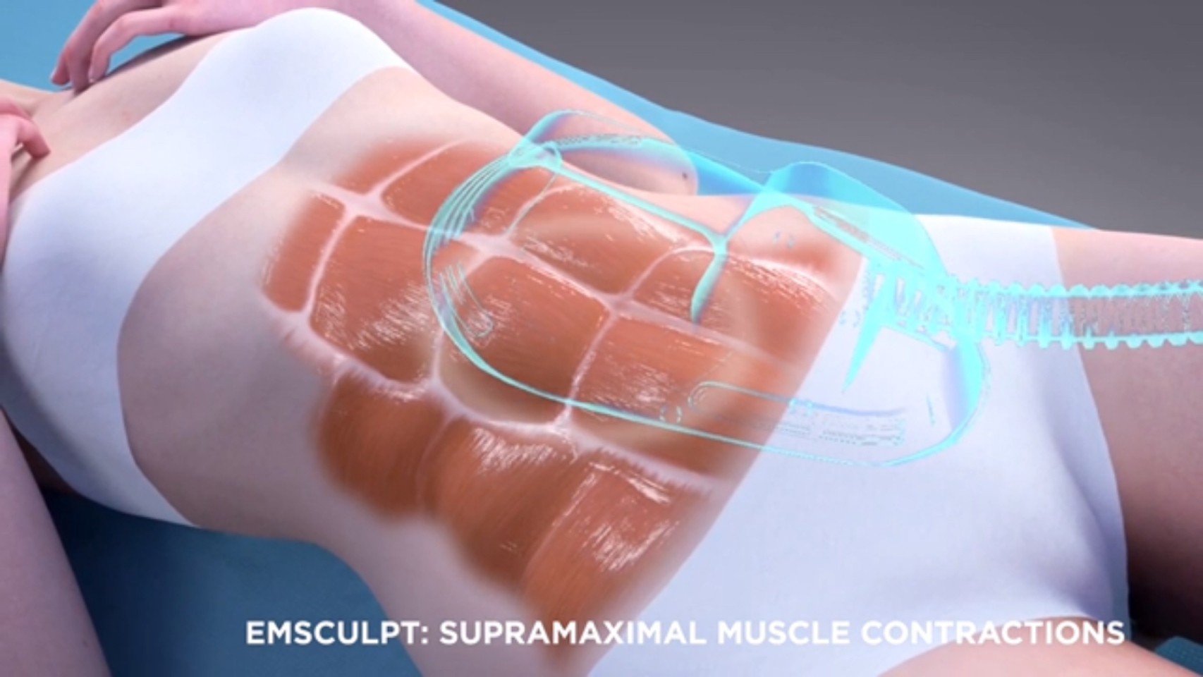 นวัตกรรมสร้างกล้ามเนื้อสลายไขมันด้วย Emsculpt นวัตกรรมสร้างกล้ามเนื้อสลายไขมันด้วย Emsculpt