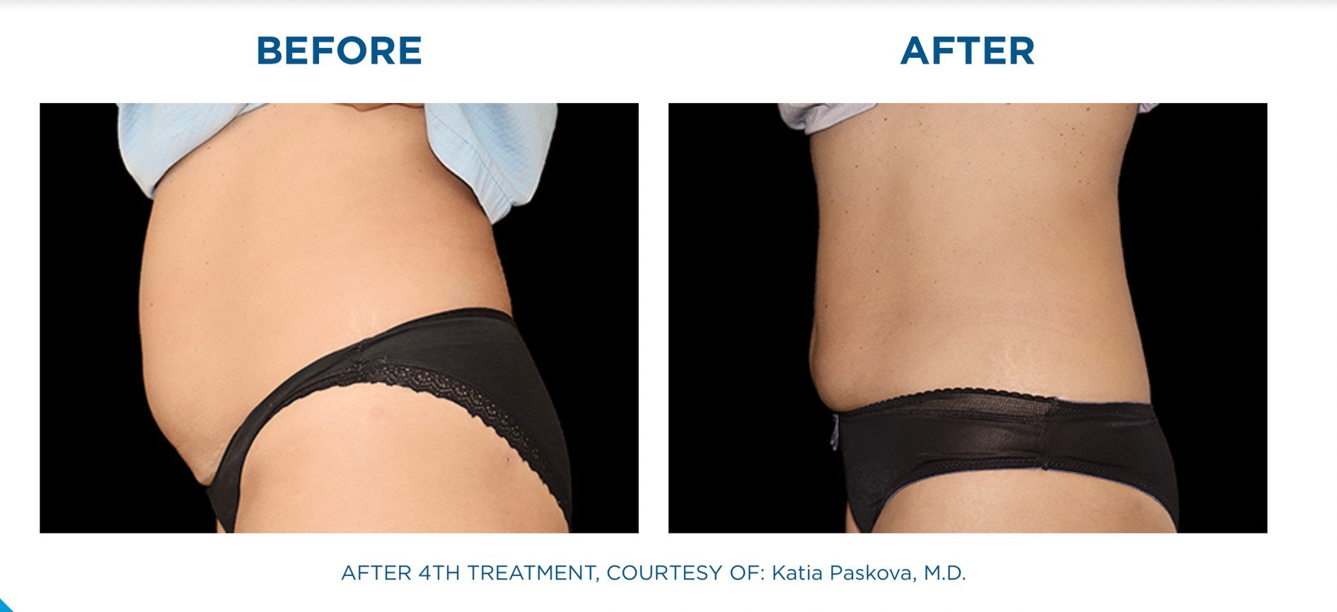 นวัตกรรมสร้างกล้ามเนื้อสลายไขมันด้วย Emsculpt นวัตกรรมสร้างกล้ามเนื้อสลายไขมันด้วย Emsculpt