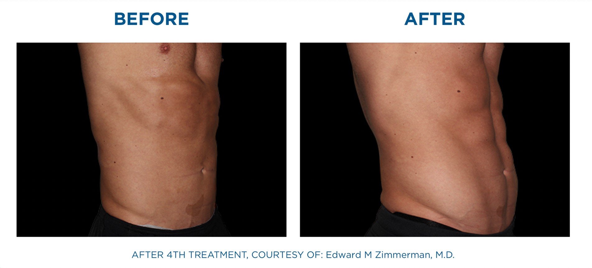 นวัตกรรมสร้างกล้ามเนื้อสลายไขมันด้วย Emsculpt นวัตกรรมสร้างกล้ามเนื้อสลายไขมันด้วย Emsculpt