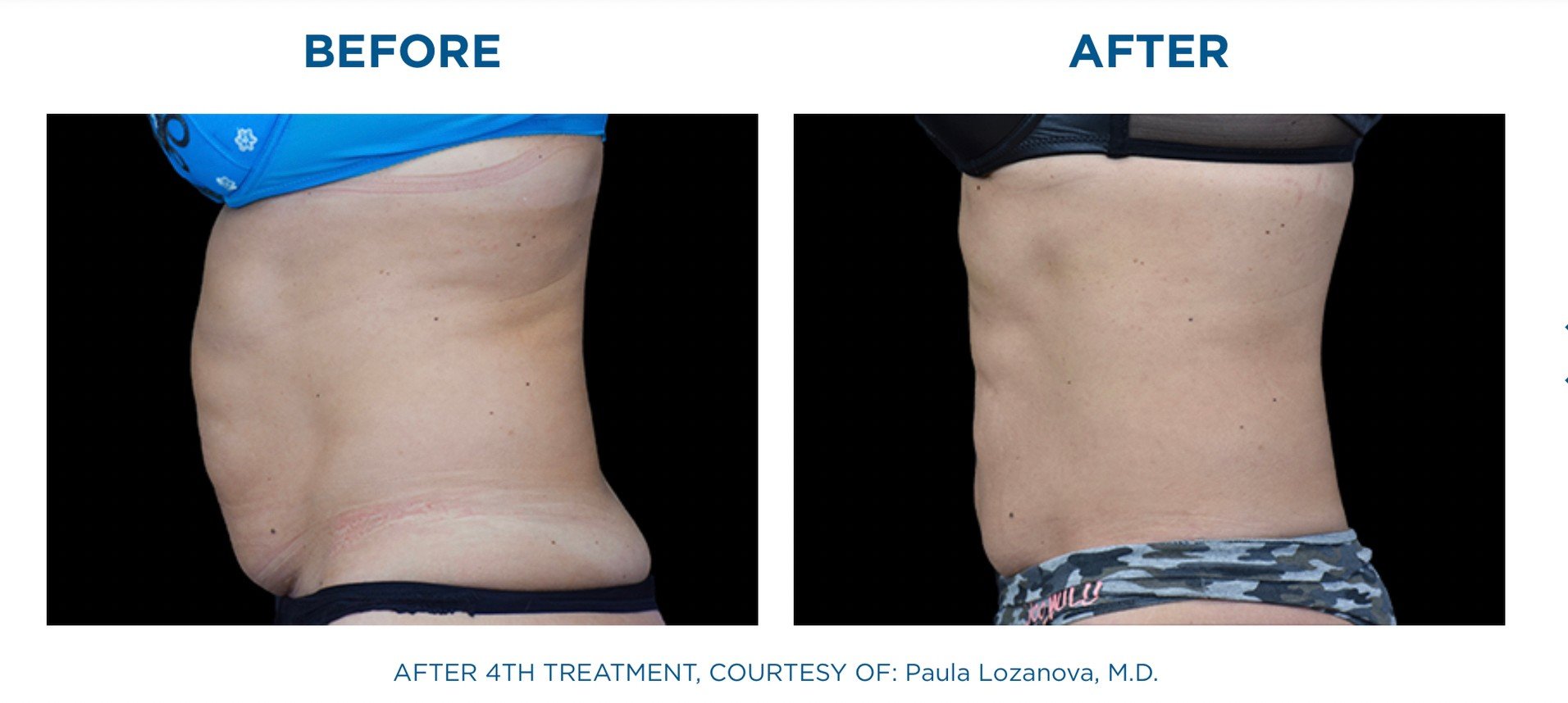 นวัตกรรมสร้างกล้ามเนื้อสลายไขมันด้วย Emsculpt นวัตกรรมสร้างกล้ามเนื้อสลายไขมันด้วย Emsculpt