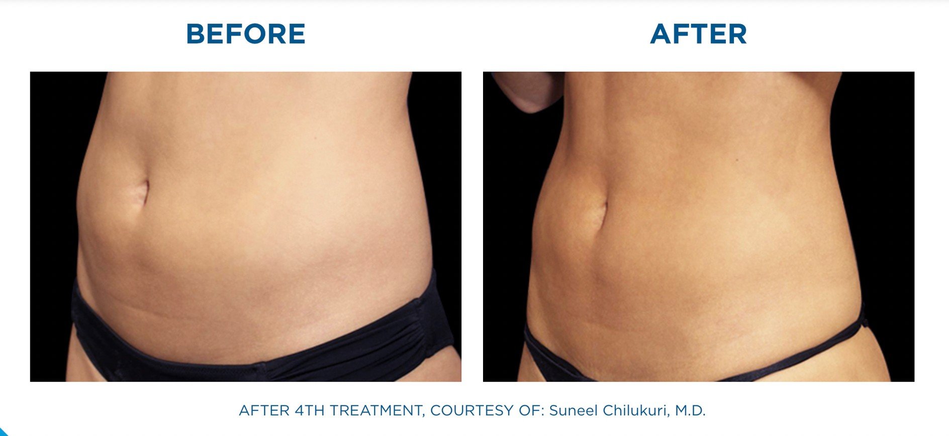 นวัตกรรมสร้างกล้ามเนื้อสลายไขมันด้วย Emsculpt นวัตกรรมสร้างกล้ามเนื้อสลายไขมันด้วย Emsculpt