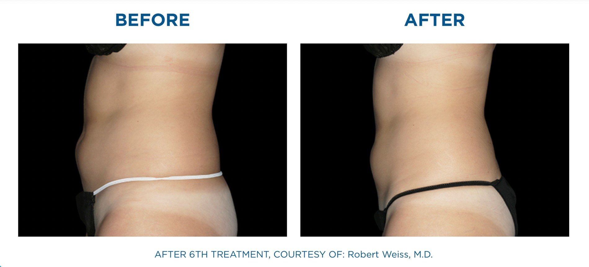 นวัตกรรมสร้างกล้ามเนื้อสลายไขมันด้วย Emsculpt นวัตกรรมสร้างกล้ามเนื้อสลายไขมันด้วย Emsculpt