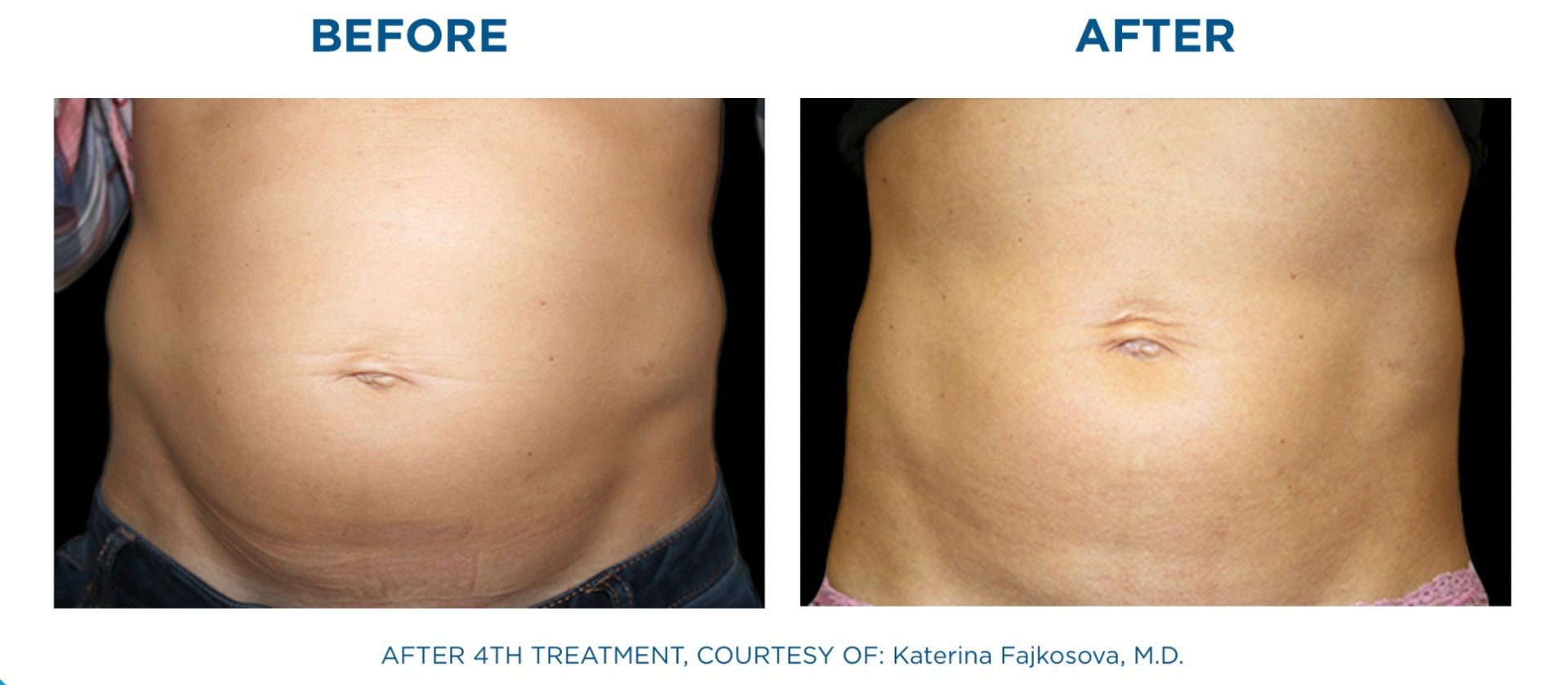 นวัตกรรมสร้างกล้ามเนื้อสลายไขมันด้วย Emsculpt นวัตกรรมสร้างกล้ามเนื้อสลายไขมันด้วย Emsculpt