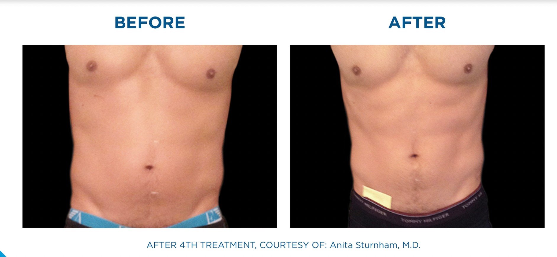 นวัตกรรมสร้างกล้ามเนื้อสลายไขมันด้วย Emsculpt นวัตกรรมสร้างกล้ามเนื้อสลายไขมันด้วย Emsculpt