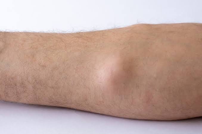 ก้อนเนื้อไขมัน หรือ เนื้องอกไขมัน (Lipoma) คืออะไร ดูแลได้อย่างไร ? ก้อนเนื้อไขมัน หรือ เนื้องอกไขมัน (Lipoma) คืออะไร ดูแลได้อย่างไร ?