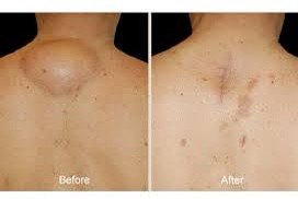 ก้อนเนื้อไขมัน หรือ เนื้องอกไขมัน (Lipoma) คืออะไร ดูแลได้อย่างไร ? ก้อนเนื้อไขมัน หรือ เนื้องอกไขมัน (Lipoma) คืออะไร ดูแลได้อย่างไร ?