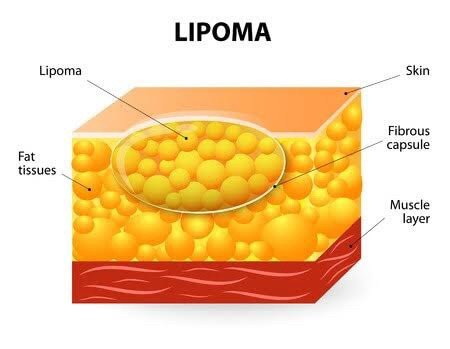 ก้อนเนื้อไขมัน หรือ เนื้องอกไขมัน (Lipoma) คืออะไร ดูแลได้อย่างไร ? ก้อนเนื้อไขมัน หรือ เนื้องอกไขมัน (Lipoma) คืออะไร ดูแลได้อย่างไร ?