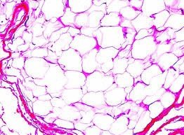 ก้อนเนื้อไขมัน หรือ เนื้องอกไขมัน (Lipoma) คืออะไร ดูแลได้อย่างไร ? ก้อนเนื้อไขมัน หรือ เนื้องอกไขมัน (Lipoma) คืออะไร ดูแลได้อย่างไร ?