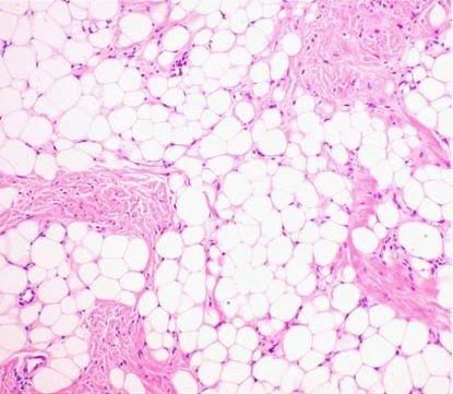 ก้อนเนื้อไขมัน หรือ เนื้องอกไขมัน (Lipoma) คืออะไร ดูแลได้อย่างไร ?